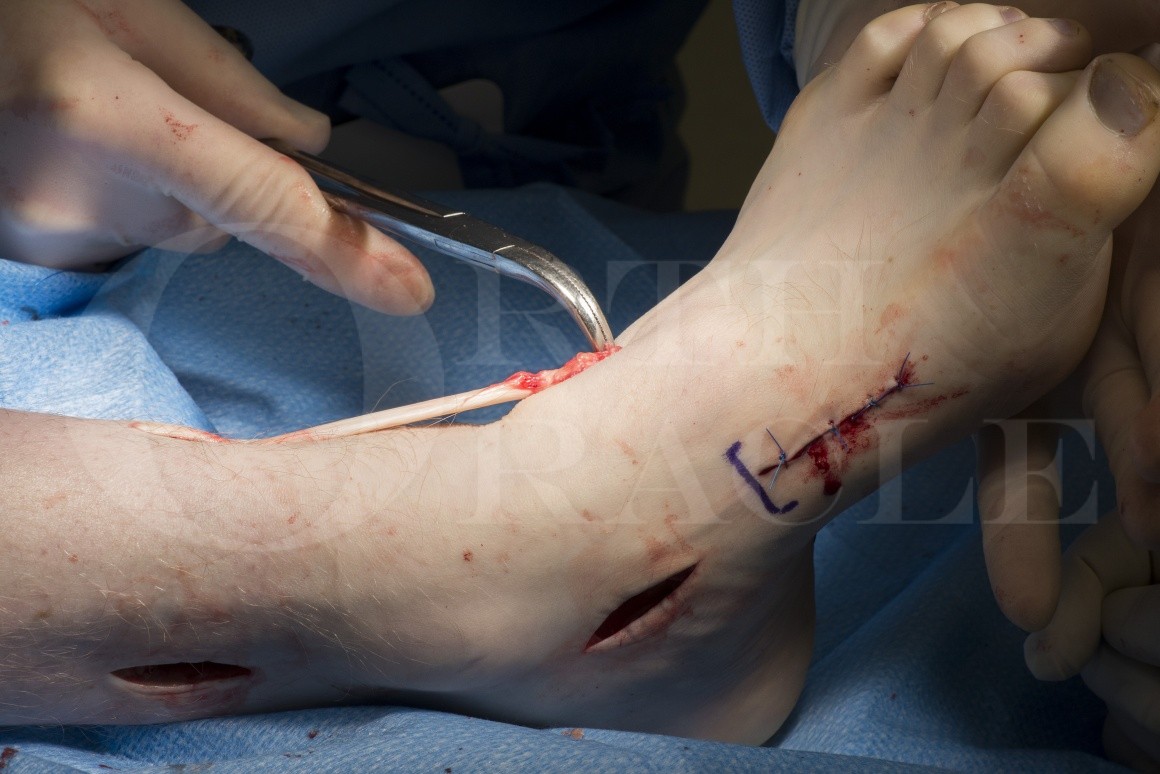 Tibialis posterior transfer (through interosseous membrane )for foot