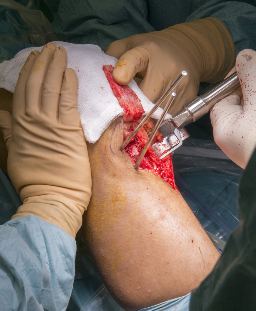 Rotational proximal tibial Osteotomy Surgical Technique - OrthOracle