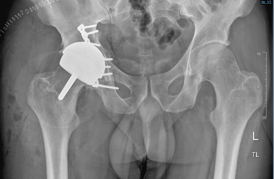 Total Hip replacement(posterior approach): Cemented Exeter