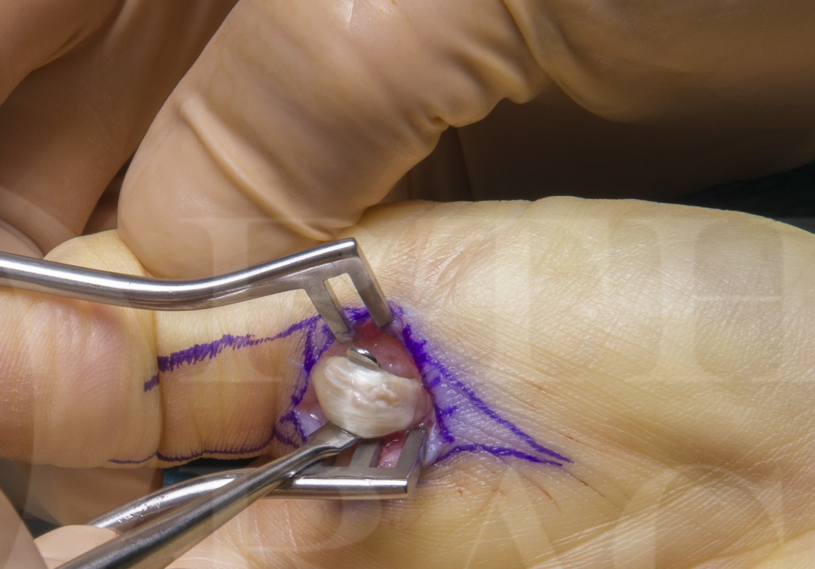 trigger finger surgery ízületek fájnak enyhíti a fájdalmat