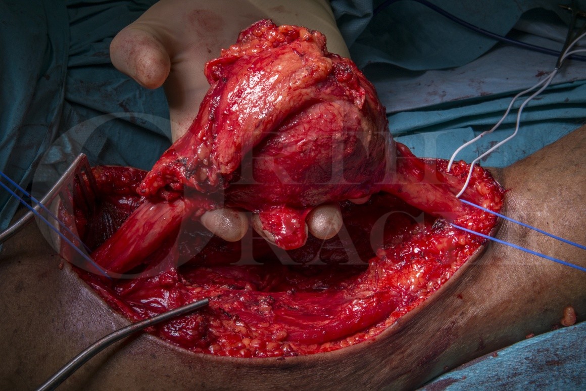 https://www.orthoracle.com/content/uploads/2019/02/284_122731_ROH_Excision-of-Malignant-Peripheral-Nerve-Sheath-Tumour-From-Sciatic-Nerve_Mike-Parry_28.01.2019-1160x774.jpg