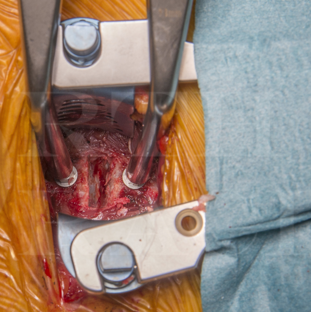 Anterior Cervical Discectomy and Fusion using the DePuy Zero-P VA cage