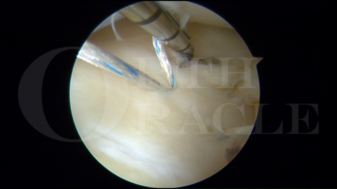 Arthroscopic lateral meniscal repair with fibrin clot and bone marrow
