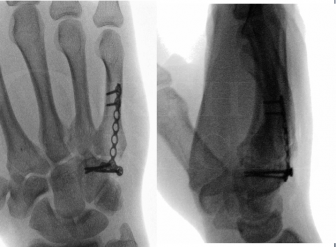 Open Reduction And Internal Fixation Of The 5th Carpometacarpal Joint With Bridging Plate Using