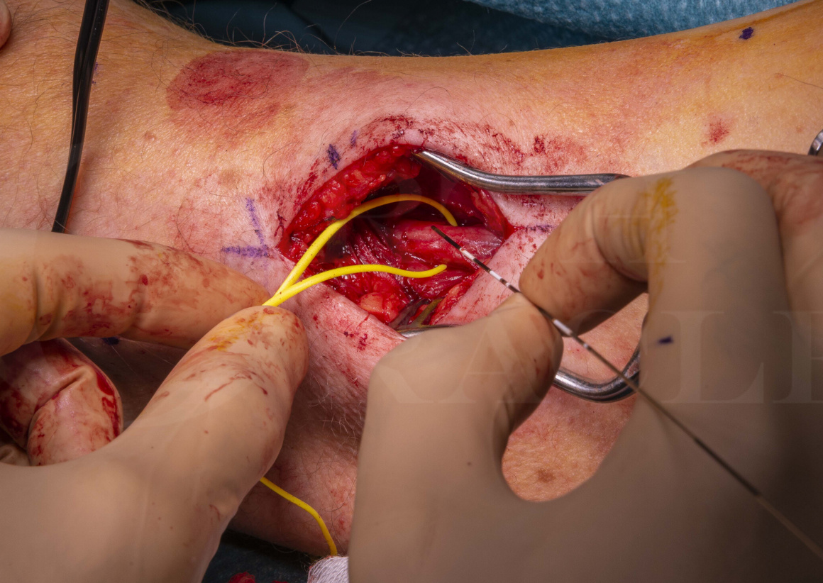 Implantation of peripheral nerve stimulator(Stimrouter neuromodulation  system) Surgical Technique - OrthOracle