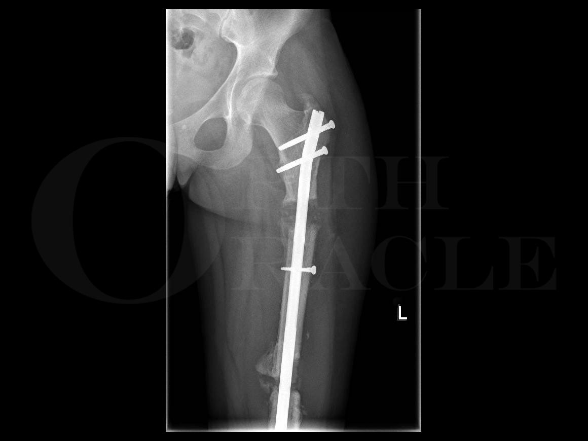 Cureus | Functional Outcomes of Tibia Fractures Treated With Intramedullary  Interlocking Nails by Suprapatellar Approach: A Prospective Study | Article